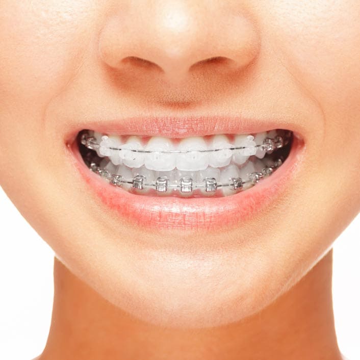 Clear Ceramic  Orthodontist in Utah County, UT